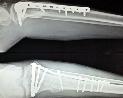 FDA Guidance on Orthopedic Fracture Fixation Plates: Testing a Validation