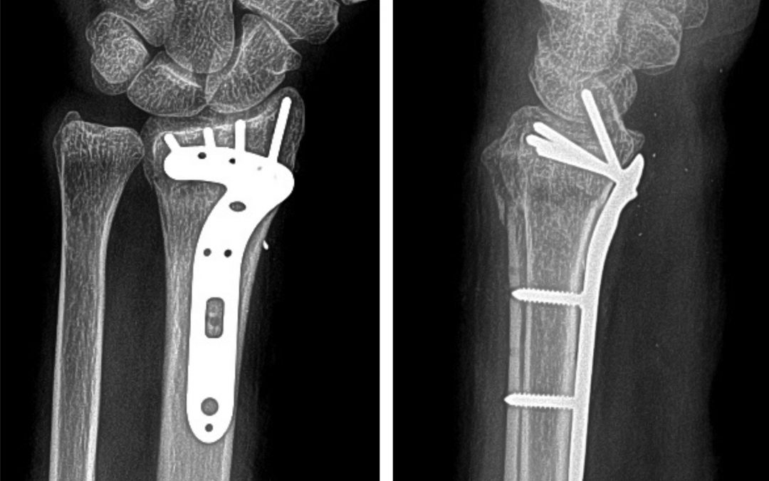 FDA Guidance on Orthopedic Fracture Fixation Plates: Overview